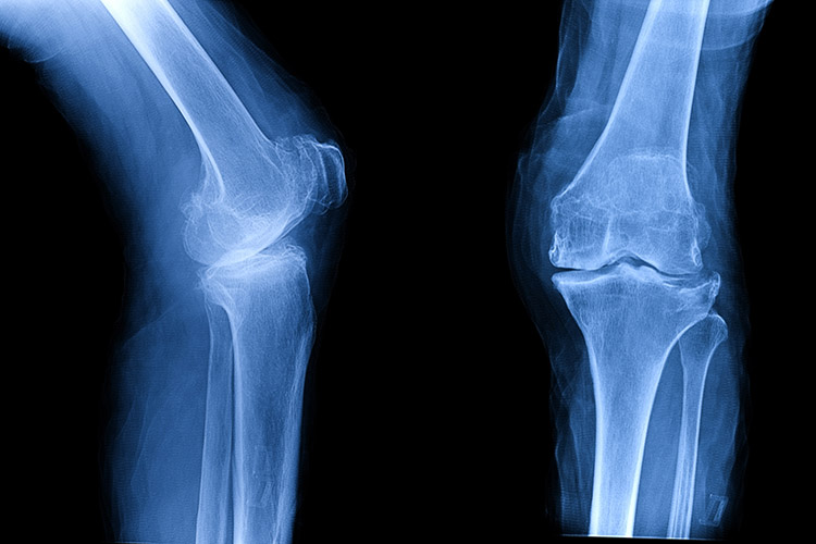 Image of 1_Update_Osteoarthritis.
